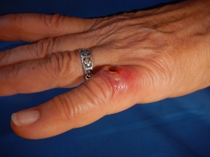 Violin Spider Bite as it looked
          early on