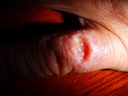 Kathys Violin Spider Bite Part way
          through treatment